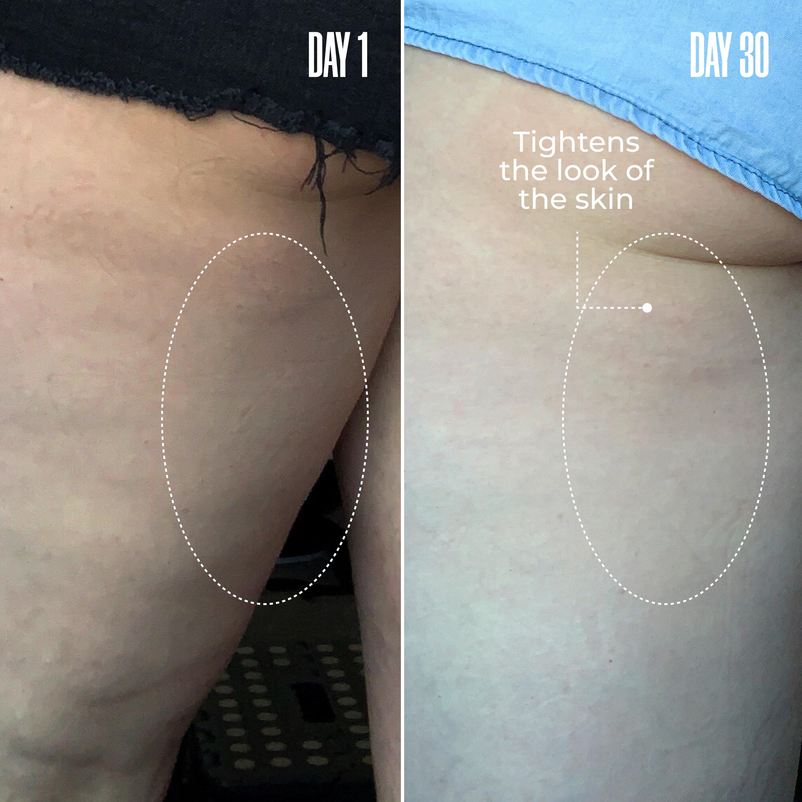 MAËLYS Cosmetics B-TIGHT Leave-On Cellulite Mask - Reduces The Appearance Of Cellulite - Visibly Tightens The Skin In The Butt Area